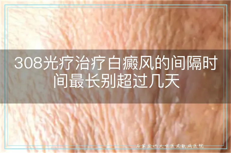 308光疗治疗白癜风的间隔时间最长别超过几天