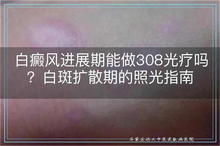 白癜风进展期能做308光疗吗?白斑扩散期的照光指南