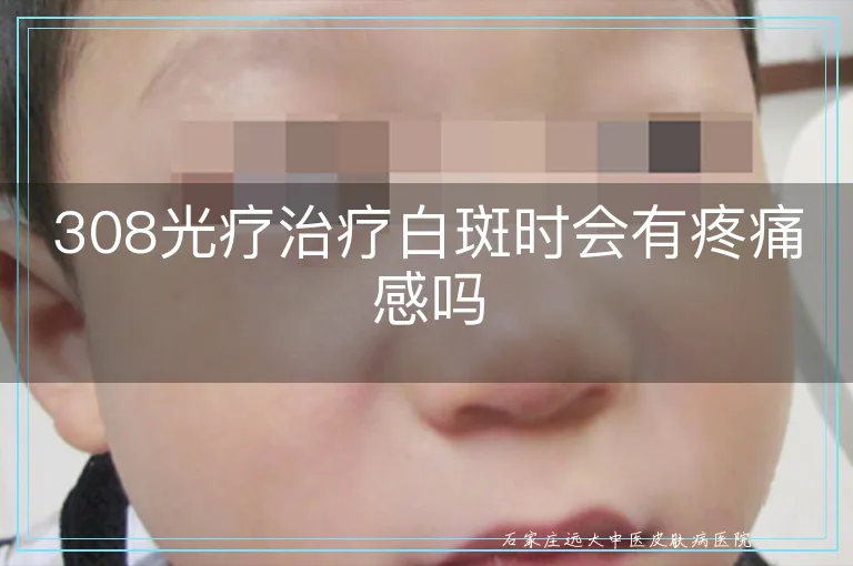 308光疗治疗白斑时会有疼痛感吗