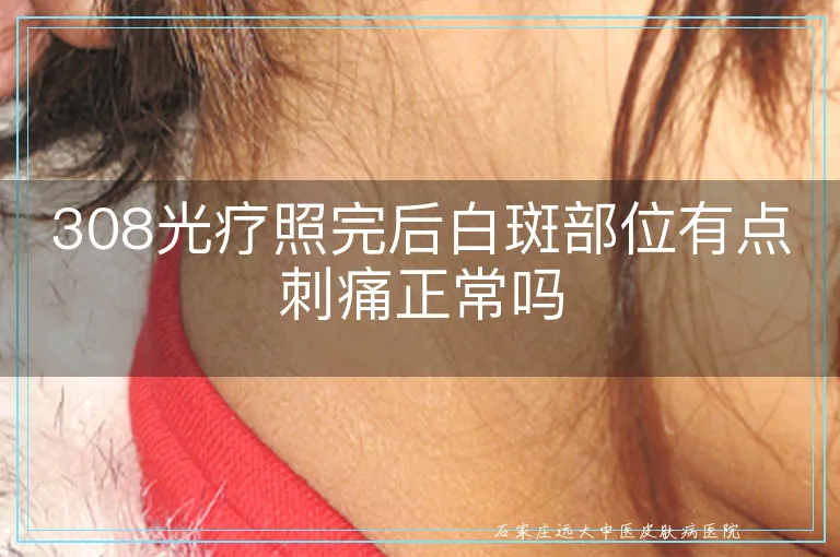 308光疗照完后白斑部位有点刺痛正常吗