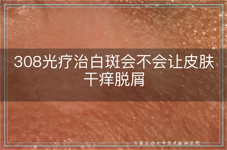 308光疗治白斑会不会让皮肤干痒脱屑