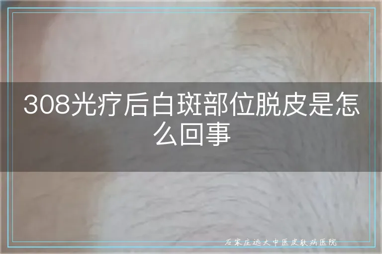 308光疗后白斑部位脱皮是怎么回事