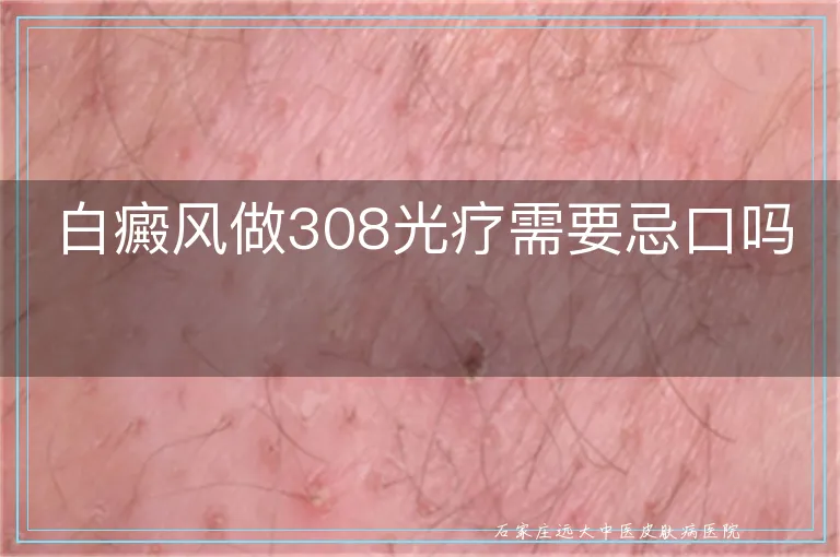 白癜风做308光疗需要忌口吗