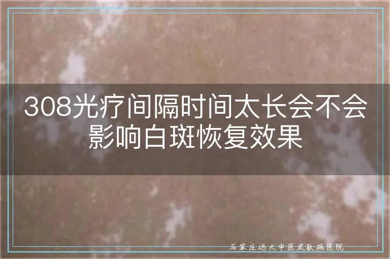 308光疗间隔时间太长会不会影响白斑恢复效果