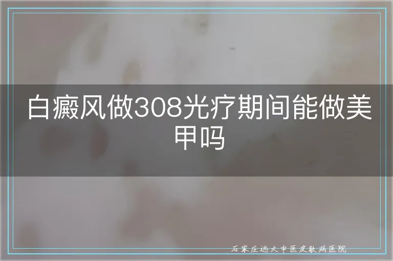 白癜风做308光疗期间能做美甲吗