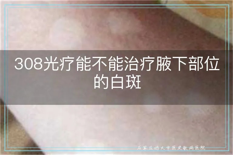 308光疗能不能治疗腋下部位的白斑