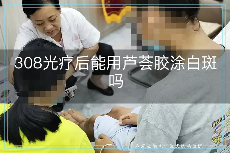 308光疗后能用芦荟胶涂白斑吗