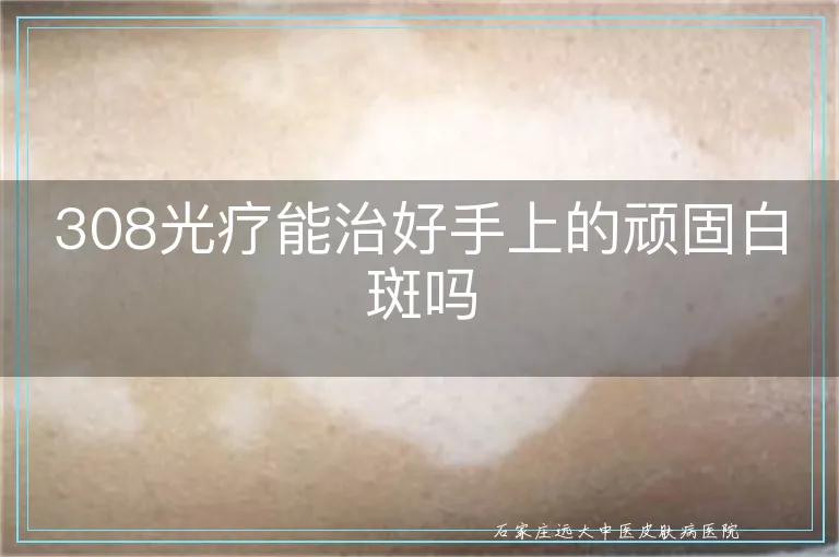 308光疗能治好手上的顽固白斑吗