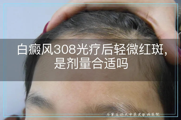 白癜风308光疗后轻微红斑,是剂量合适吗