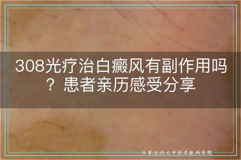 308光疗治白癜风有副作用吗?患者亲历感受分享