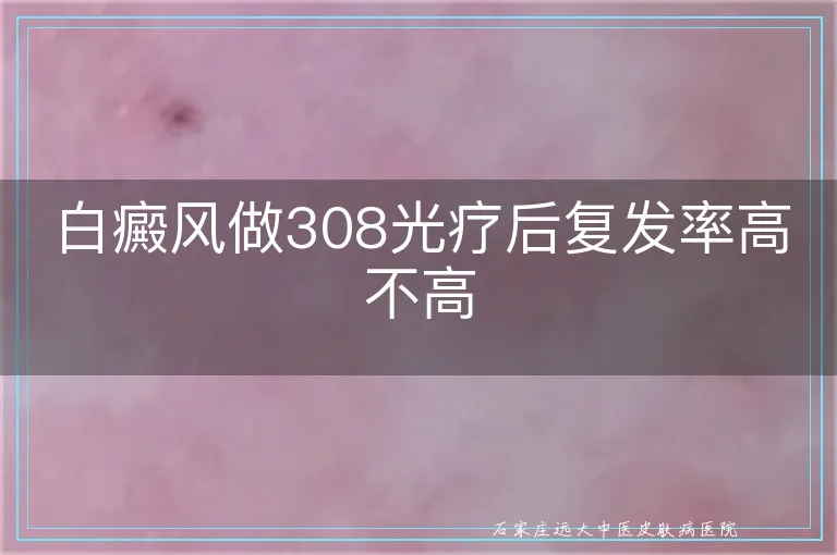 白癜风做308光疗后复发率高不高