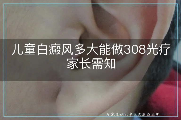 儿童白癜风多大能做308光疗家长需知