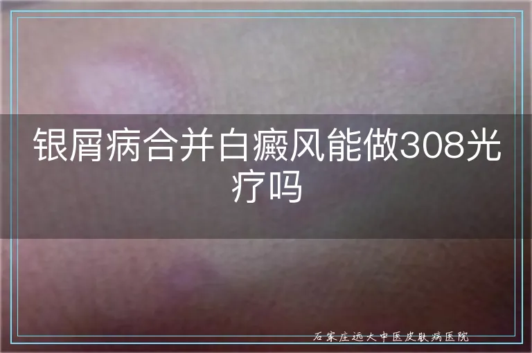 银屑病合并白癜风能做308光疗吗