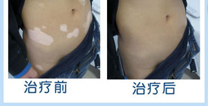 儿童嘴角白癜风康复案例