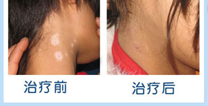 脸部眼角白癜风康复案例