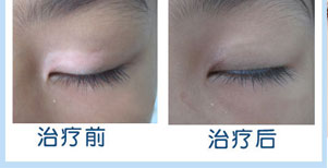 腋下周围白癜风康复案例