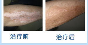 白癜风康复案例