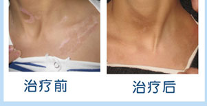 儿童面部白癜风康复案例