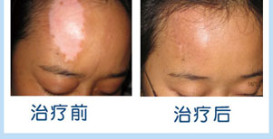 背部白癜风康复案例