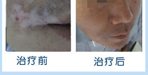 全身白癜风康复案例