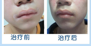 双臂白癜风康复案例